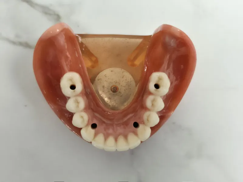 Lucrare protetică văzută dinspre interior: dinți ceramici, gingie roz și orificii de prindere