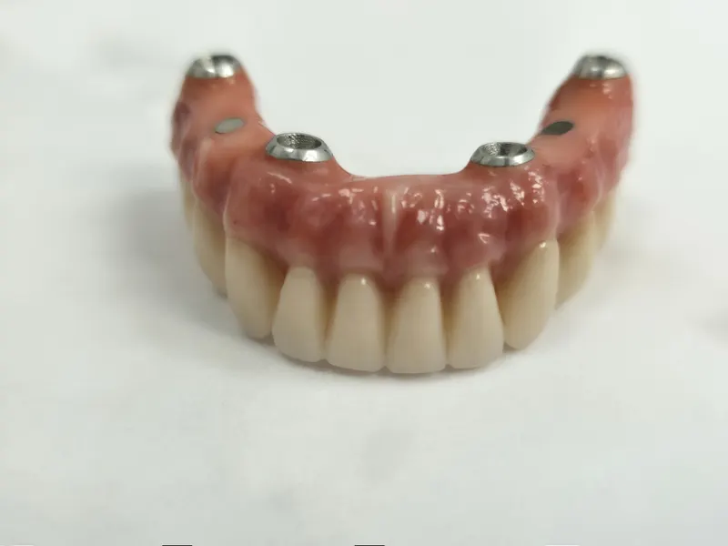 Lucrare protetică pe implanturi, cu dinți ceramici, gingie roz și trei piese metalice de prindere