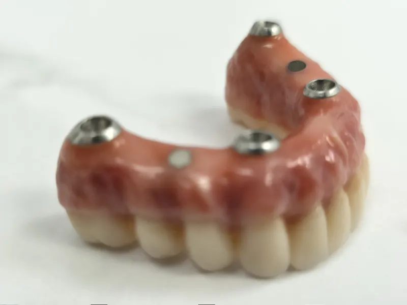Arcadă fixă cu dinți ceramici și gingie roz, cu piesele metalice de prindere vizibile
