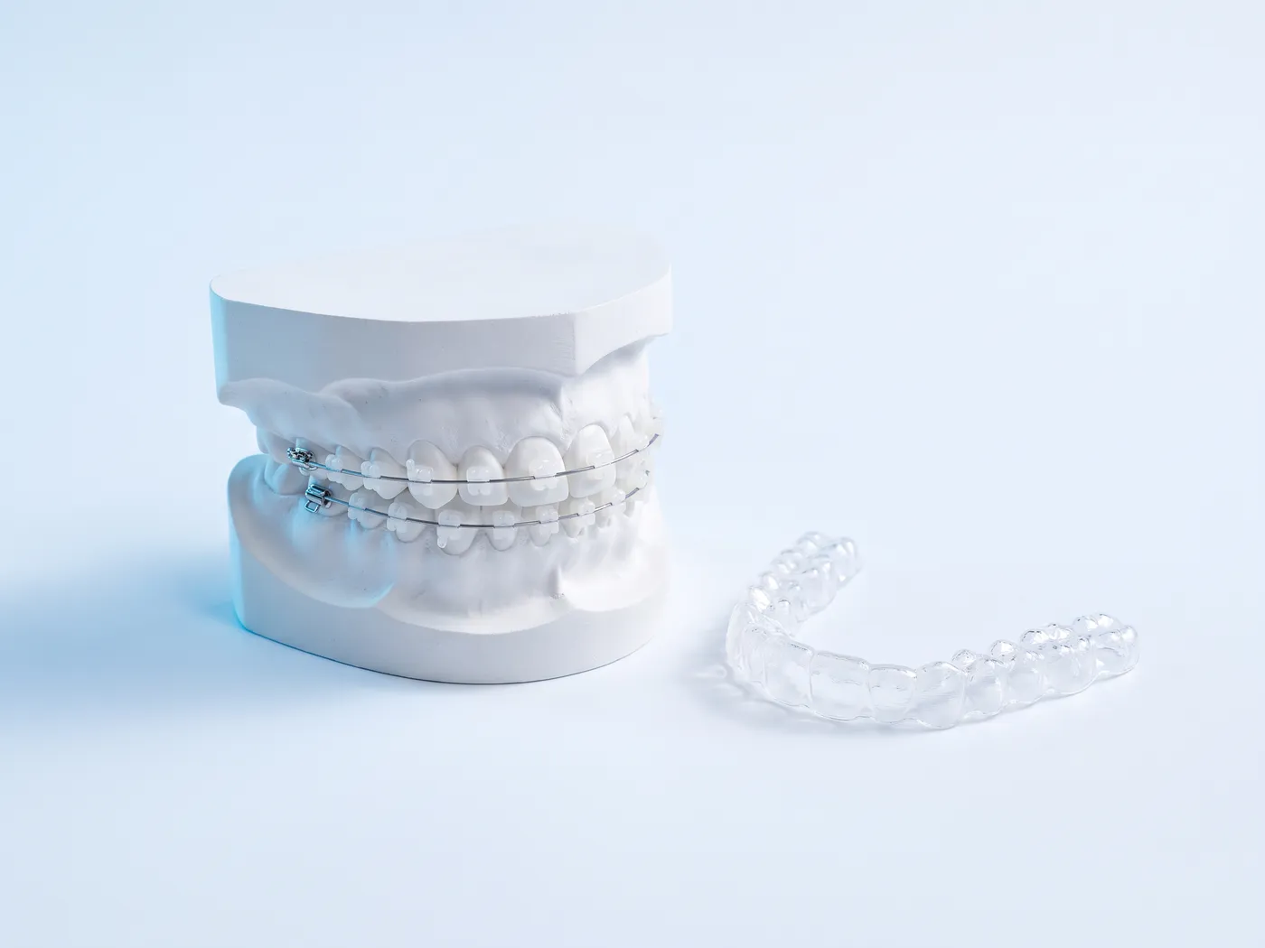 Model de arcadă cu aparat dentar cu brackeți ceramici și o gutieră de contenție