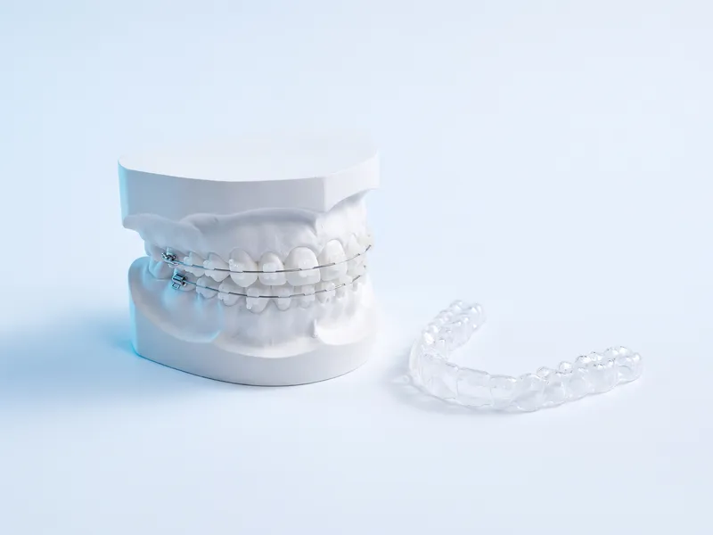 Model de arcadă cu aparat dentar cu brackeți ceramici